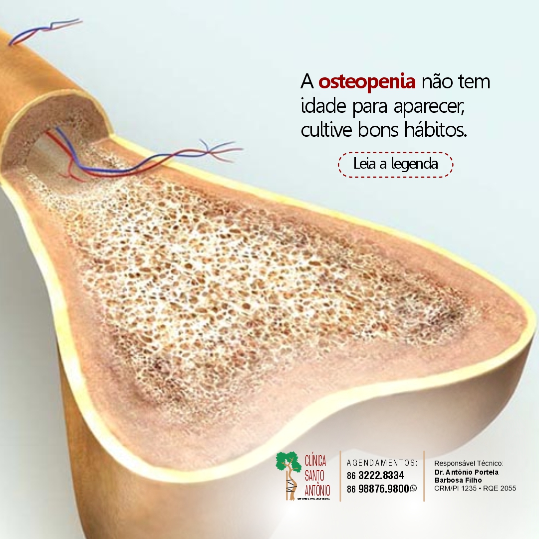 No momento, você está visualizando Osteopenia