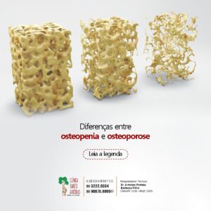 Leia mais sobre o artigo Diferença entre osteopenia e osteoporose