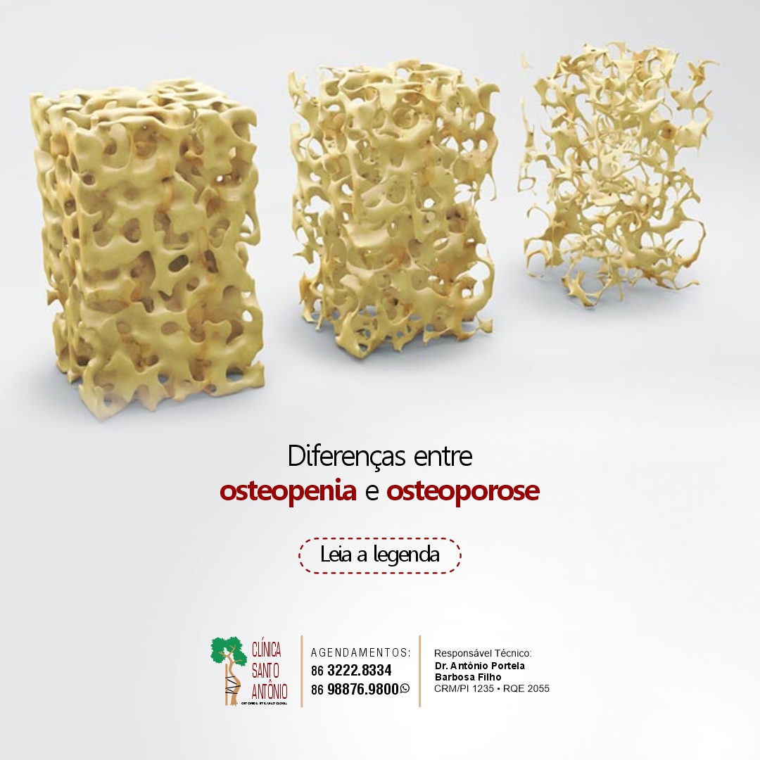 No momento, você está visualizando Diferença entre osteopenia e osteoporose