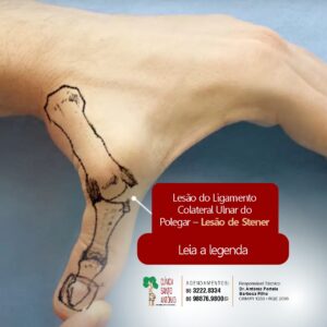 Leia mais sobre o artigo Lesão de Stener