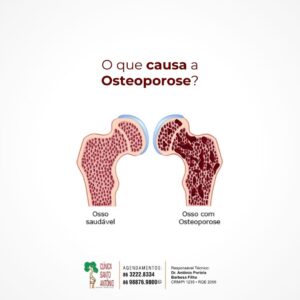 Leia mais sobre o artigo O que causa osteoporose?