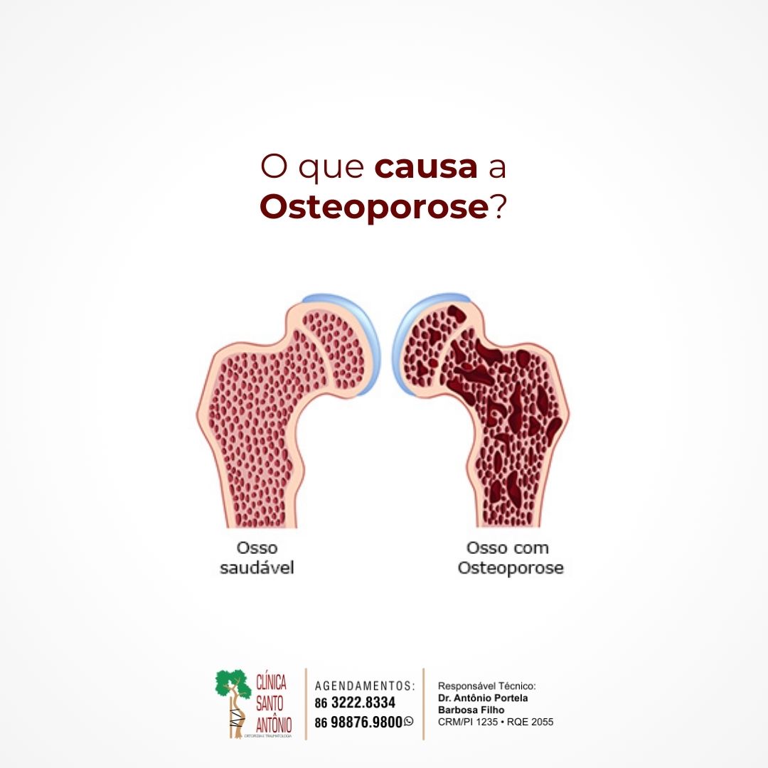 No momento, você está visualizando O que causa osteoporose?