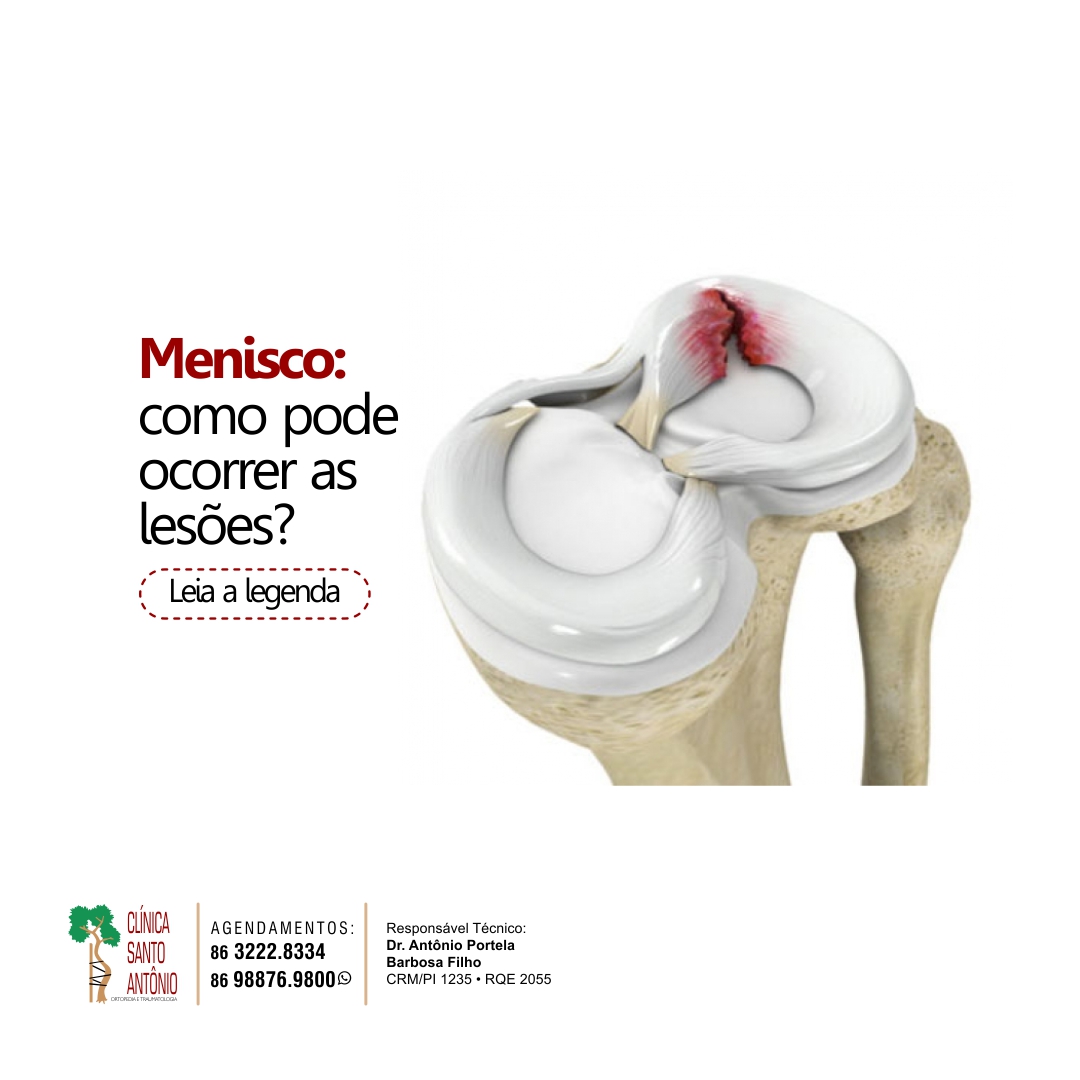 No momento, você está visualizando Lesões no Menisco