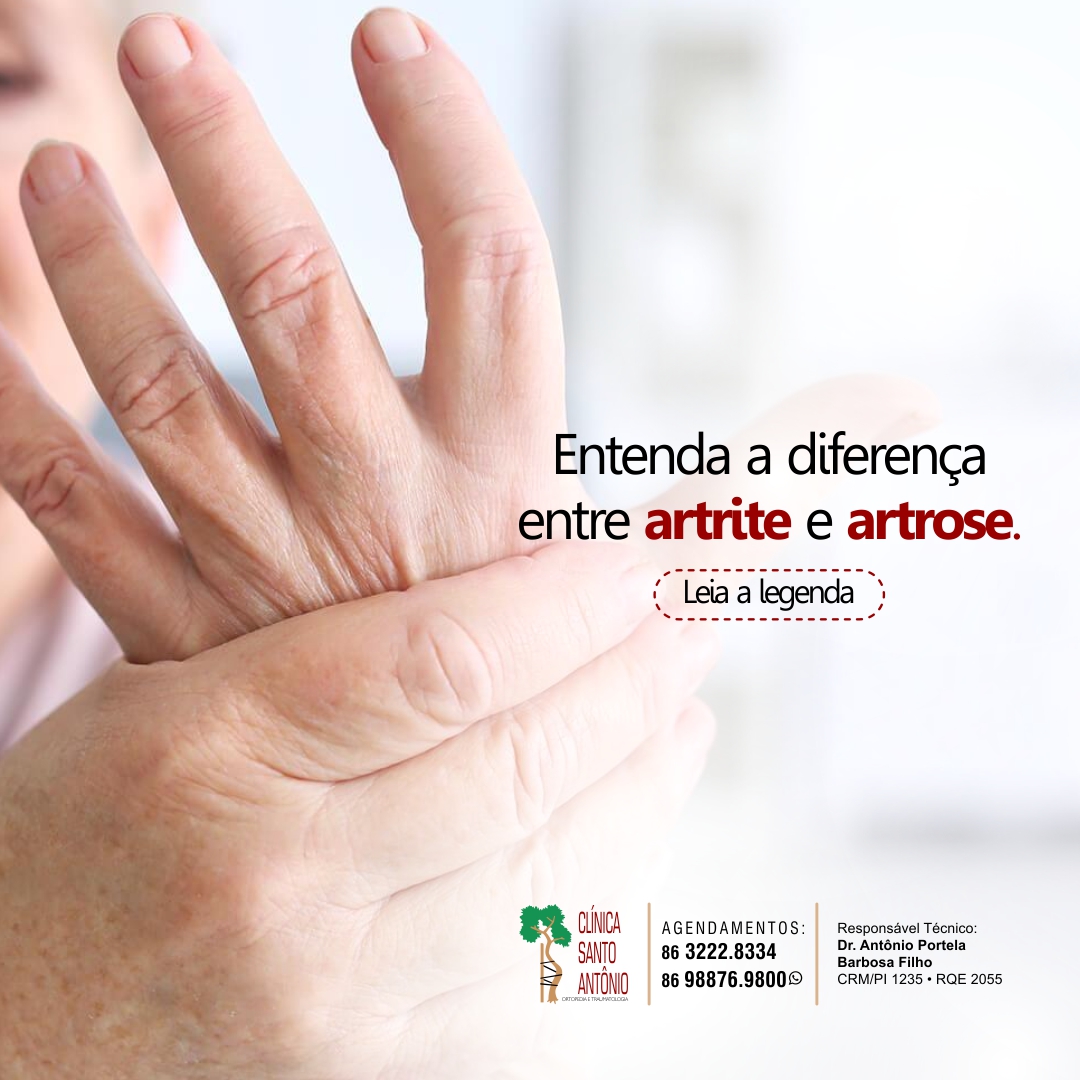 Leia mais sobre o artigo Entenda a diferença entre artrite e artrose.