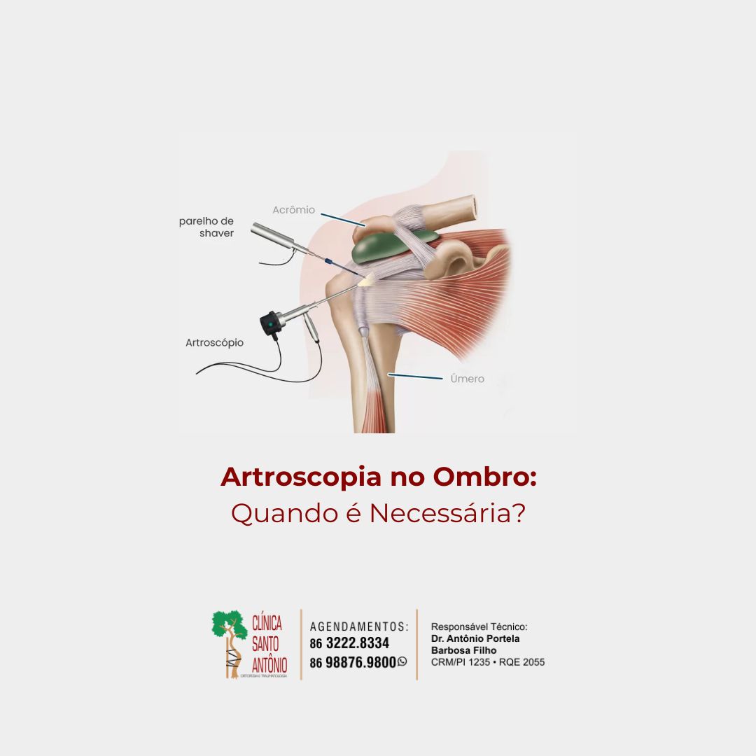 Leia mais sobre o artigo Artroscopia no ombro: quando é necessária?
