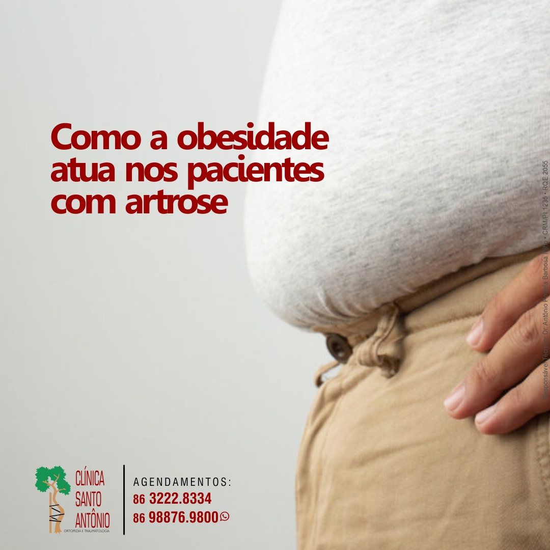 Leia mais sobre o artigo Artrose x obesidade