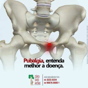 Leia mais sobre o artigo Pubalgia