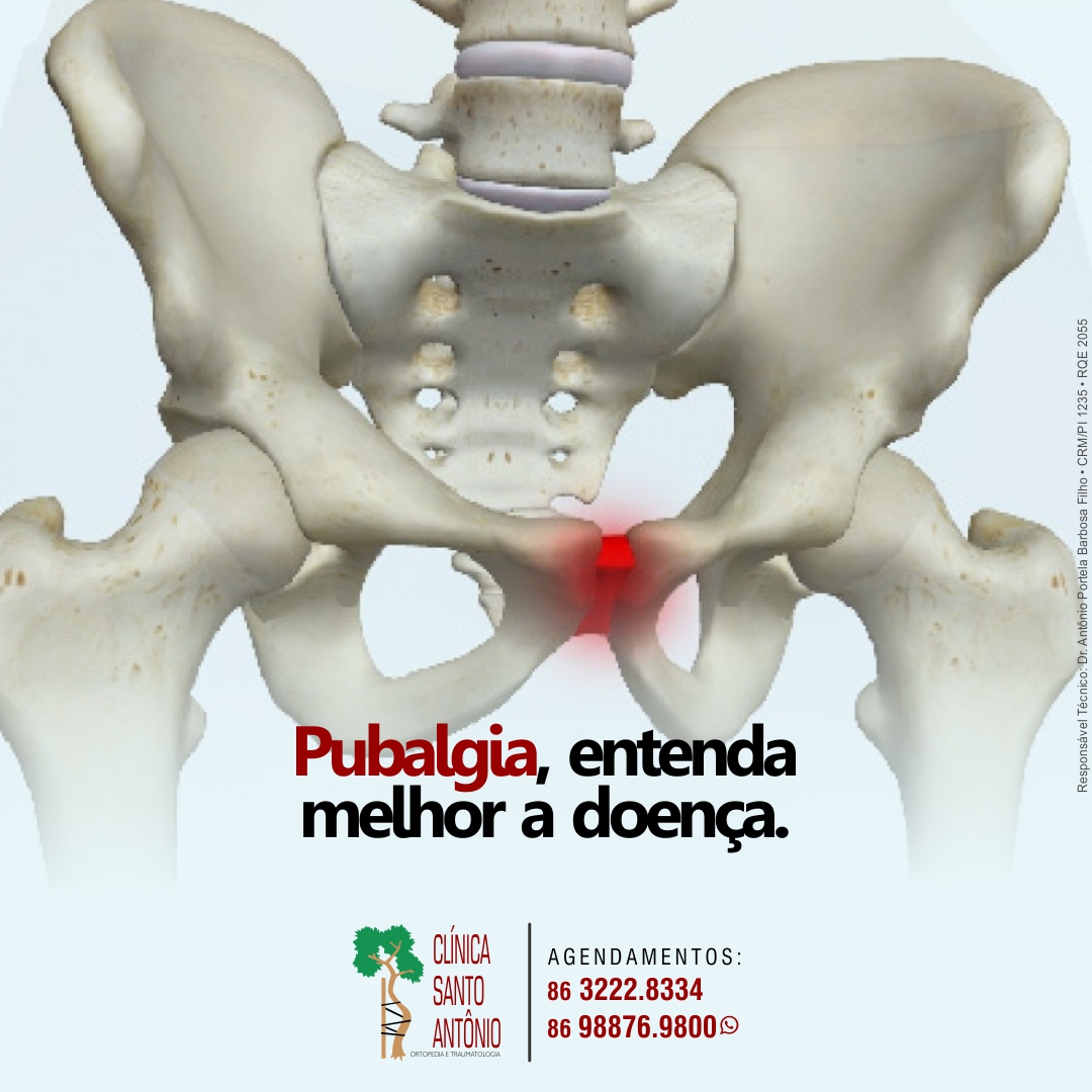 Leia mais sobre o artigo Pubalgia
