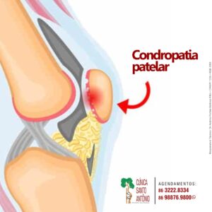 Leia mais sobre o artigo Condropatia Patelar