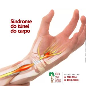 Leia mais sobre o artigo Síndrome do Túnel do carpo