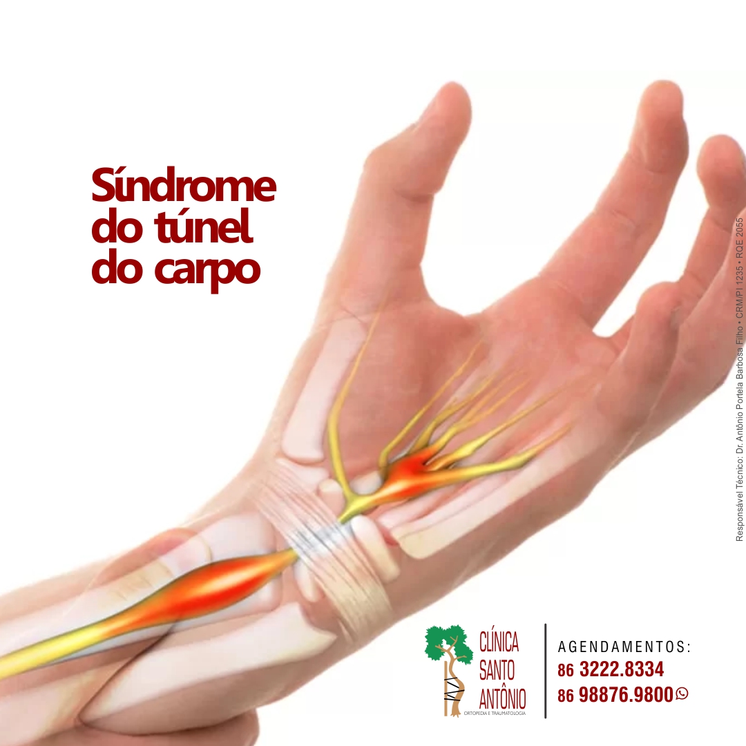 Leia mais sobre o artigo Síndrome do Túnel do carpo