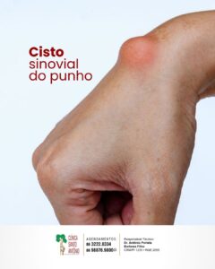 Leia mais sobre o artigo Cisto sinovial de punho