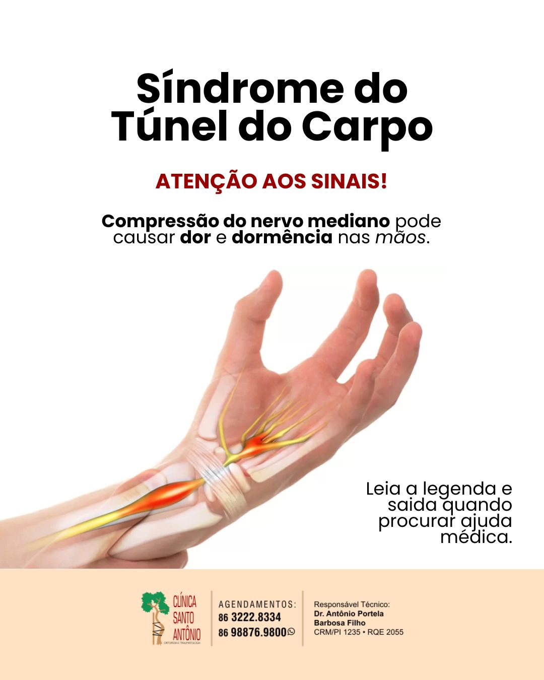 Leia mais sobre o artigo Síndrome do túnel do carpo