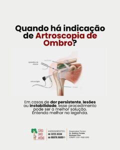 Leia mais sobre o artigo Artroscopia de ombro: quando é indicada!