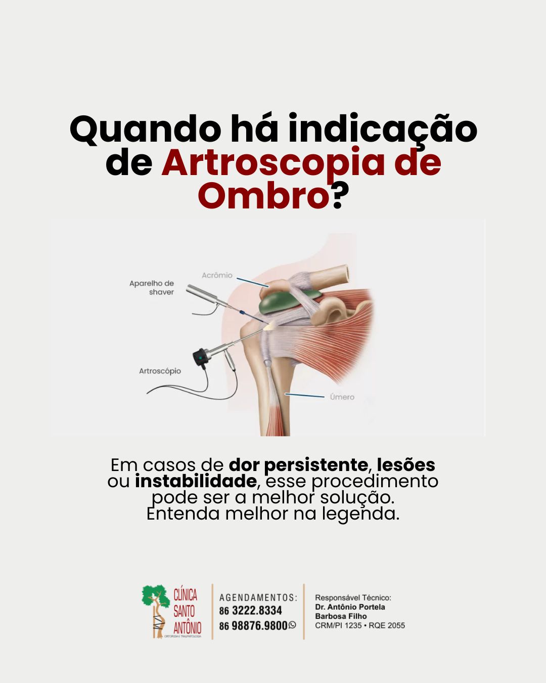 Leia mais sobre o artigo Artroscopia de ombro: quando é indicada!