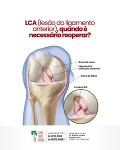Leia mais sobre o artigo Quando é necessário reoperar LCA