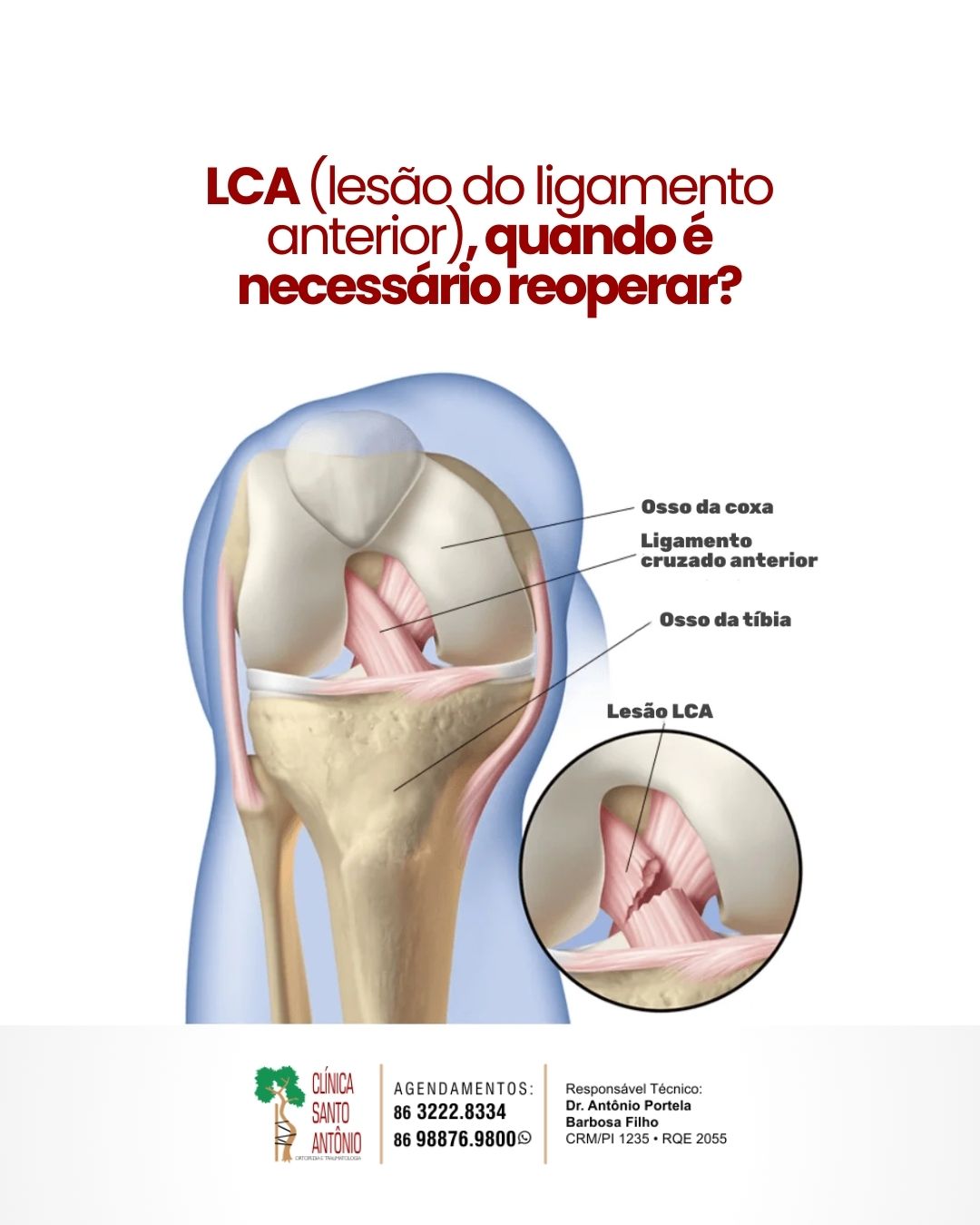 Leia mais sobre o artigo Quando é necessário reoperar LCA