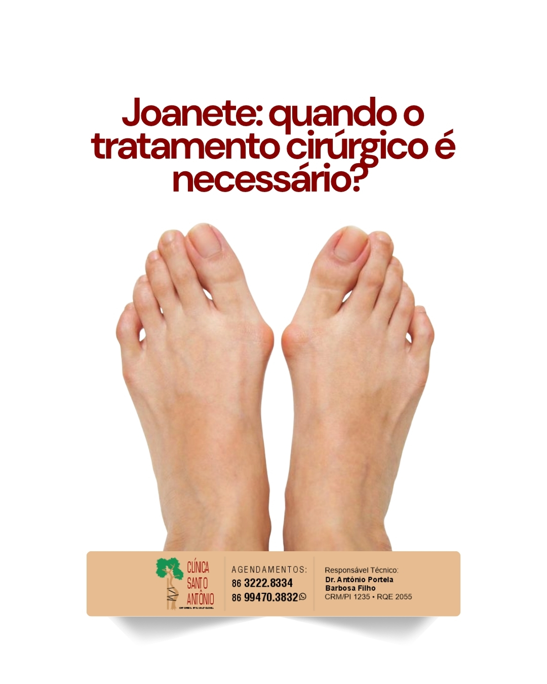 Leia mais sobre o artigo O joanete vai muito além de uma questão estética. ⚠️