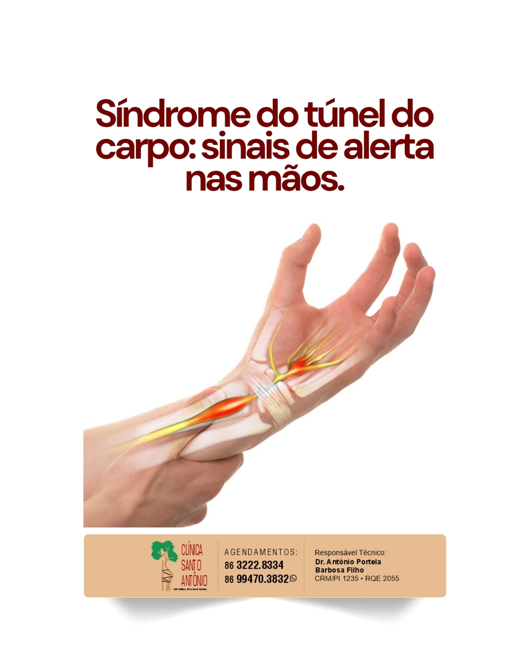 Leia mais sobre o artigo Síndrome do túnel do carpo